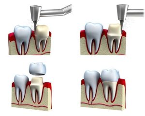 فرآیند قرار گرفتن روکش روی دندان 