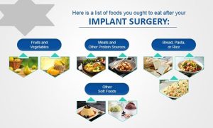 پس از جراحی ایمپلنت دندانی از چه غذاهایی باید اجتناب کرد؟
