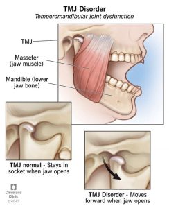 علائم اختلال TMJ یا TMD